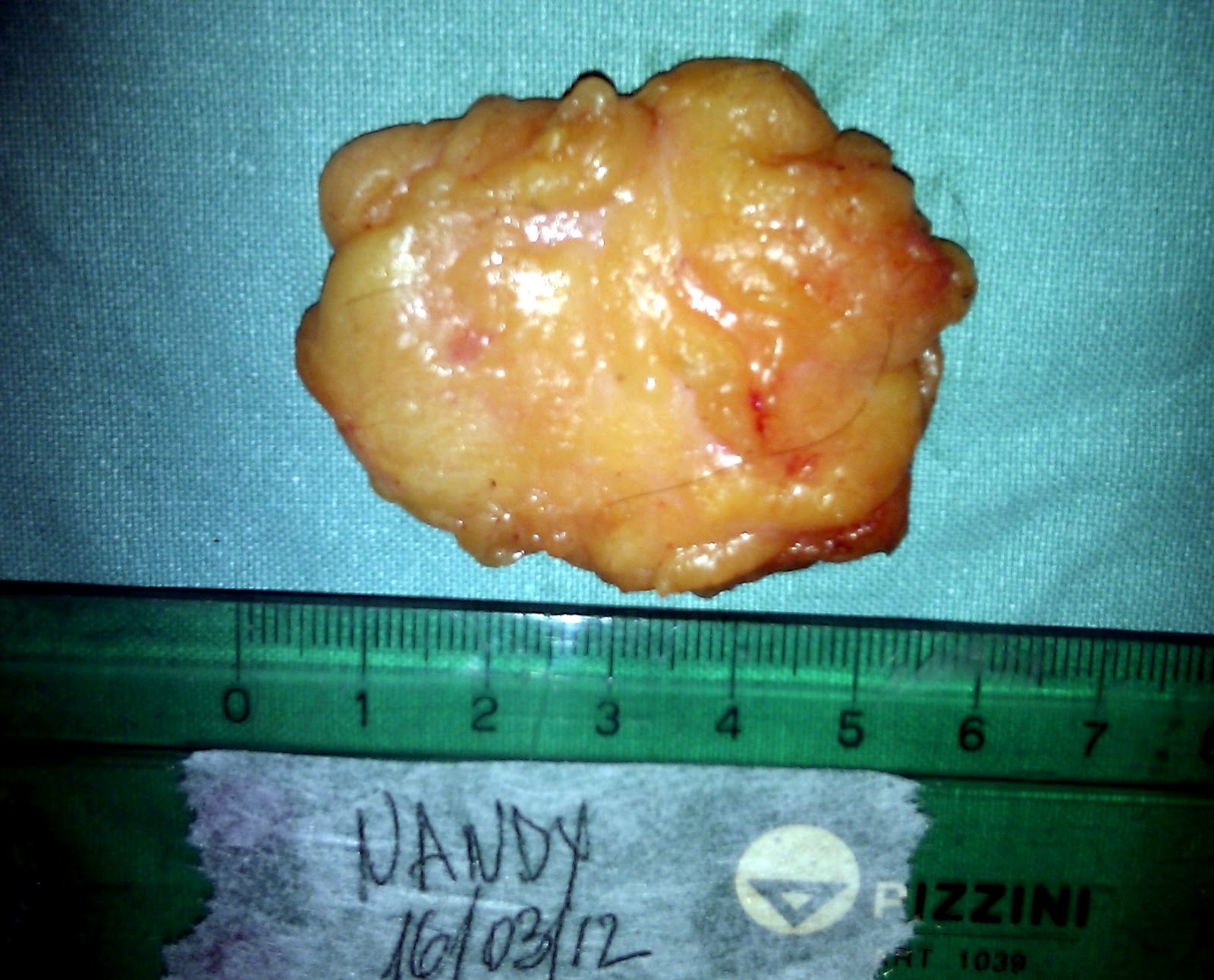 lipoma de axila
